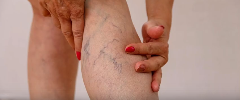 Лечение варикизной болезни