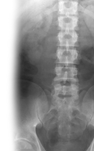 Рентгенография почек и мочевыводящих путей