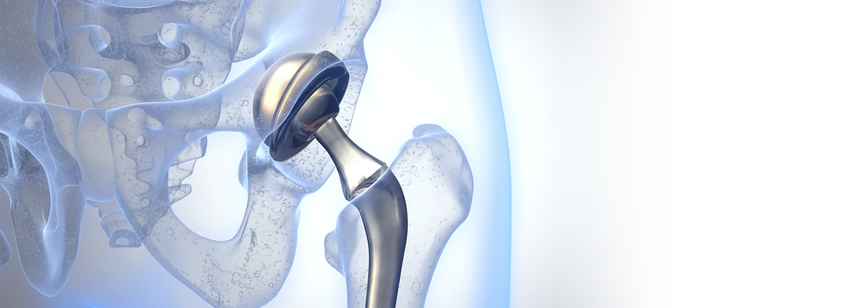 Эндопротезирование суставов