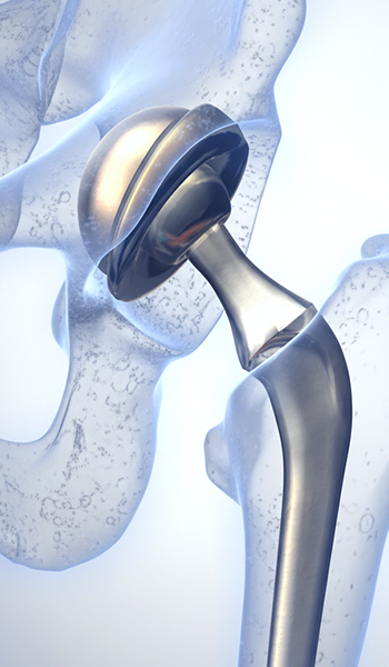 Эндопротезирование суставов со скидкой 15%