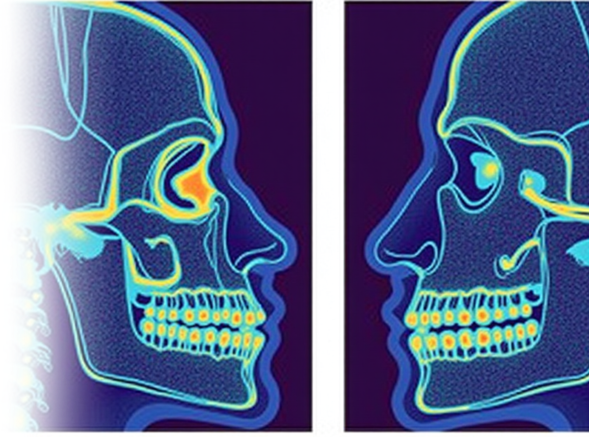 КТ костей лицевого черепа
