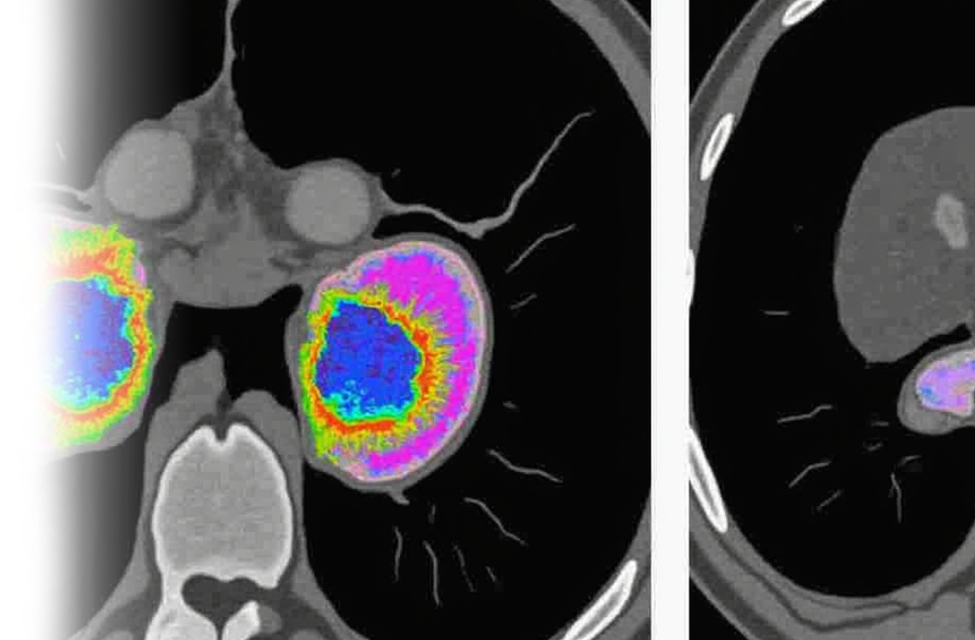 КТ почек и надпочечников