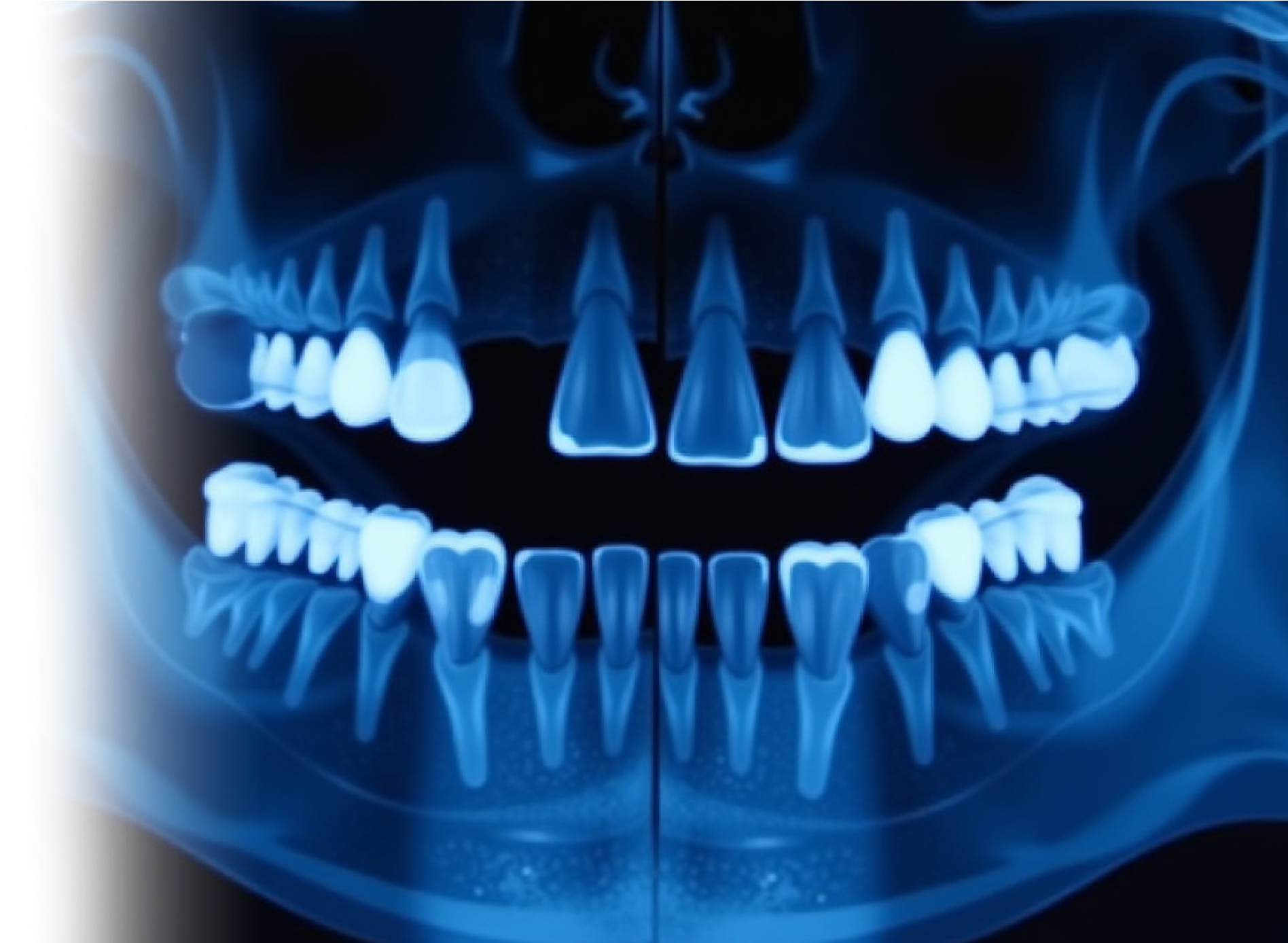 КТ верхней и нижней челюсти