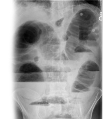 Обзорная рентгенография органов брюшной полости