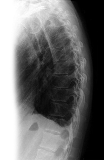 Рентгенография органов грудной клетки