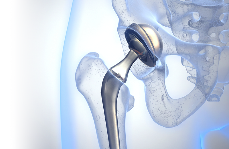 Эндопротезирование суставов со скидкой 15%