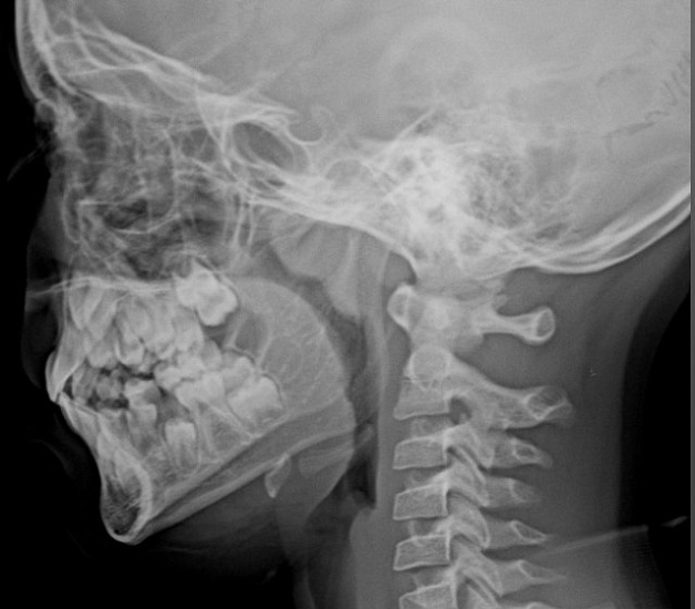 Рентгенография носоглотки