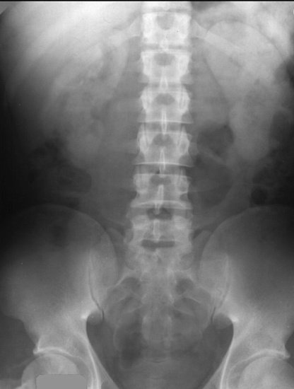 Рентгенография почек и мочевыводящих путей