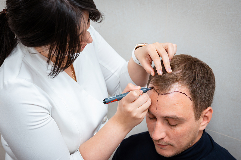 Трансплантация волос