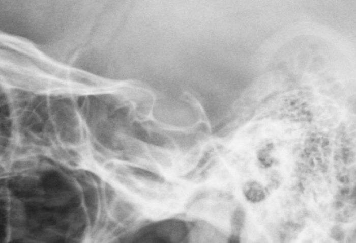 Рентген турецкого седла