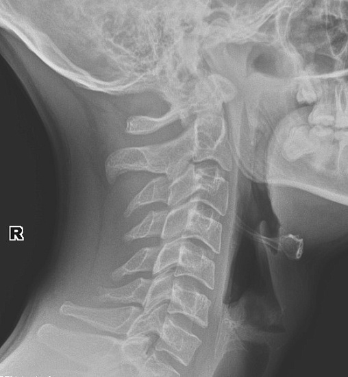 Рентгенография гортани в боковой проекции
