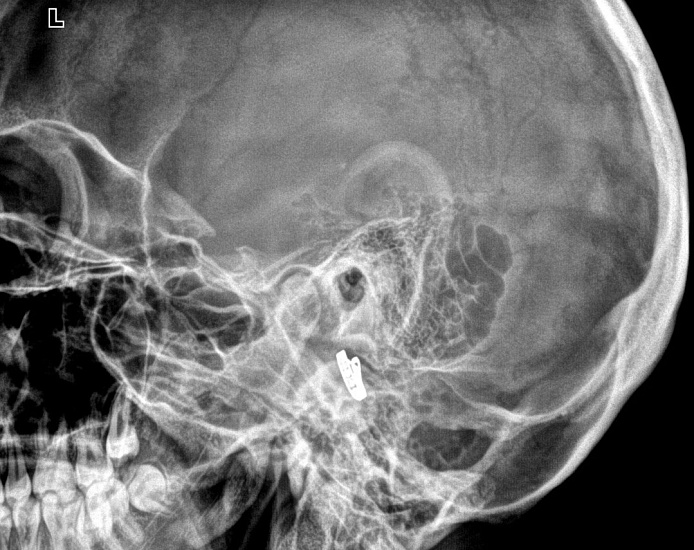 Рентгенография височных костей