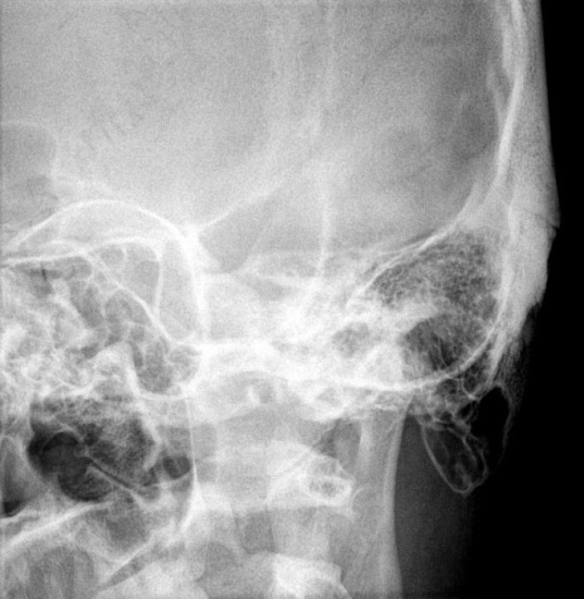 Рентгенография височных костей