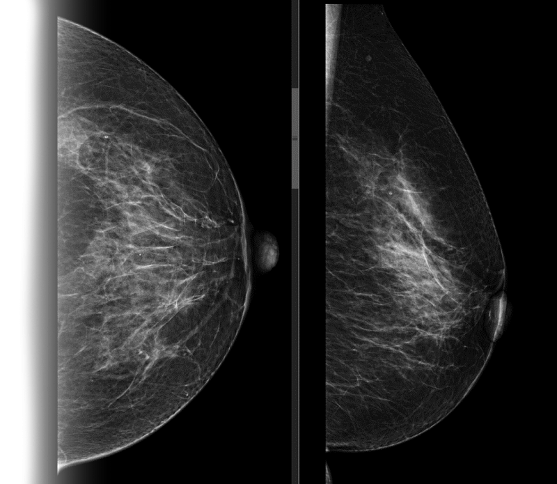 Маммография