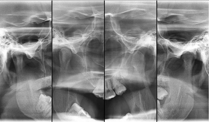 Рентгенография височно-нижнечелюстного сустава