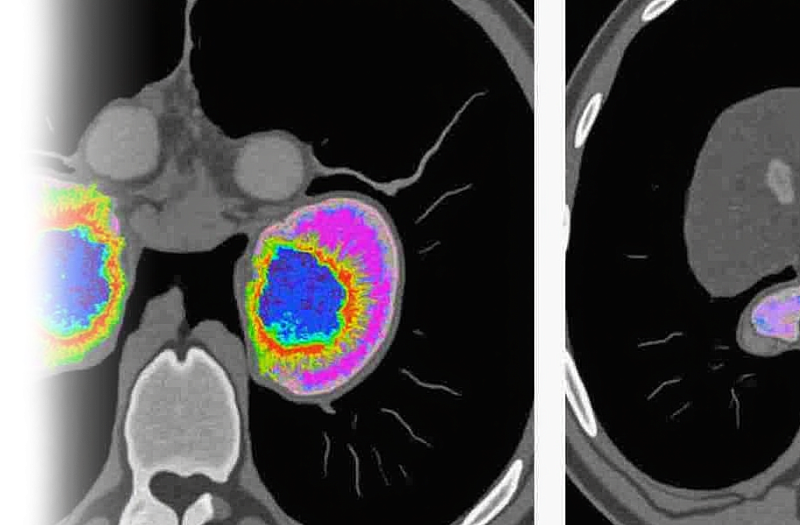 КТ почек и надпочечников
