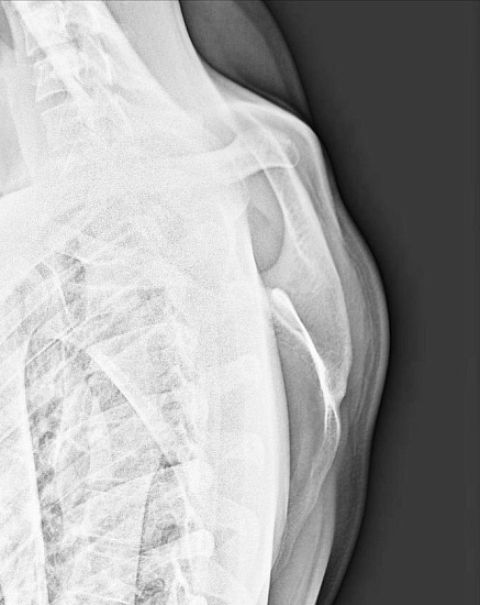 Рентгенография лопатки