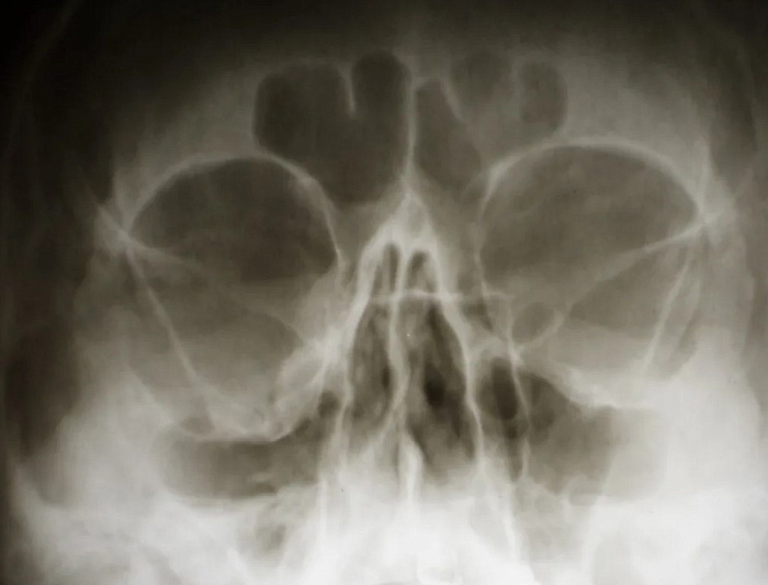 Рентгенография глазницы